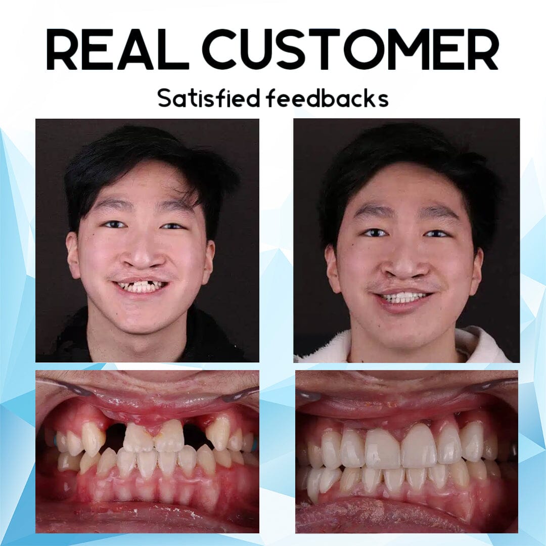 Furzero™ Silicone Reline Denture Set🦷