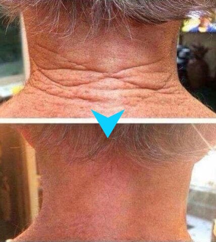 ๐ท๐ง๐๐๐ฌ๐ญ ๐๐๐ฒ ๐๐ข๐ฌ๐๐จ๐ฎ๐ง๐ญ: ๐๐% ๐๐
๐
Furzeroยฎ SkinFirming Rejuvenating Cream