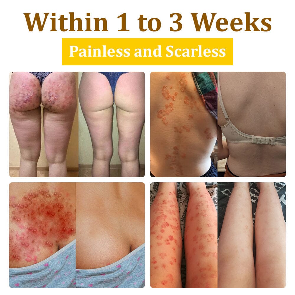 đâ
flysmus⢠Bee Venom Treatment Creamđ: Helps with Eczema, Psoriasis, Acne, Rosacea, Fungal Infections, and Warts