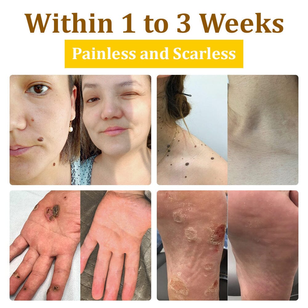 đâ
flysmus⢠Bee Venom Treatment Creamđ: Helps with Eczema, Psoriasis, Acne, Rosacea, Fungal Infections, and Warts