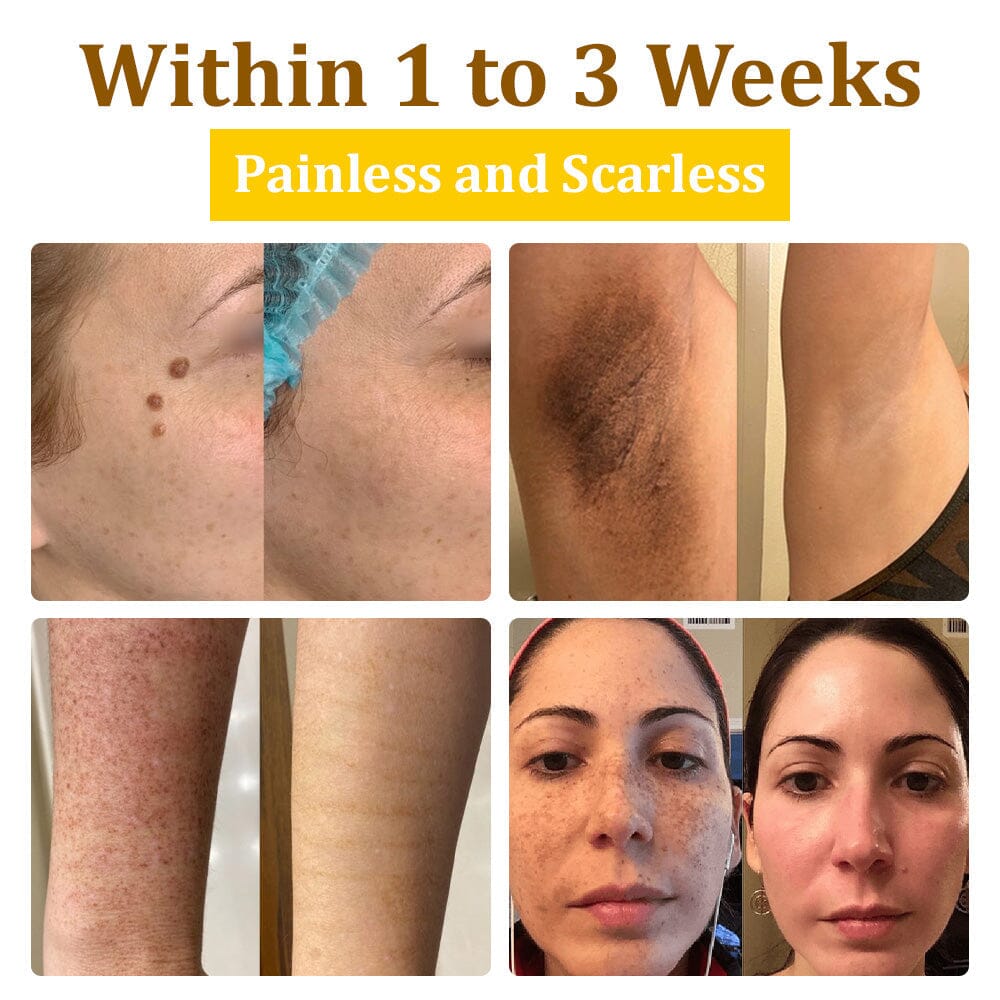 đâ
flysmus⢠Bee Venom Treatment Creamđ: Helps with Eczema, Psoriasis, Acne, Rosacea, Fungal Infections, and Warts
