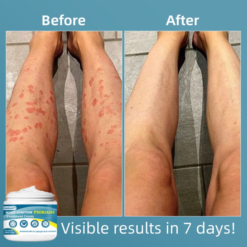 Ourlyard™ Multi-Symptom Psoriasis Treatment Cream(👨⚕Doctor's Recommendation)