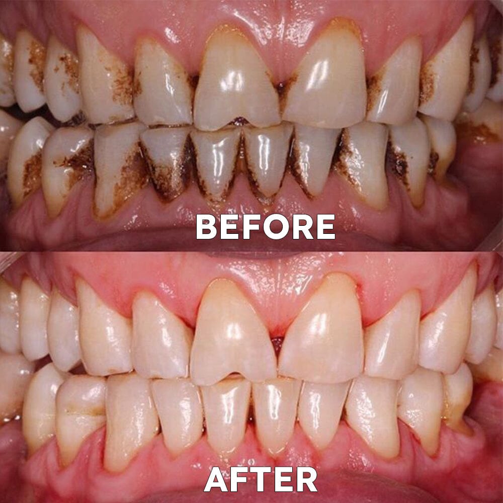 ✅Official Store | Ourlyard™ Tooth Health Mineral Powder🧑🏽⚕️Obtain American Dental Association (ADA) Certification(Treats periodontitis and mouth ulcers, prevents tooth loss, and repairs gum recession)