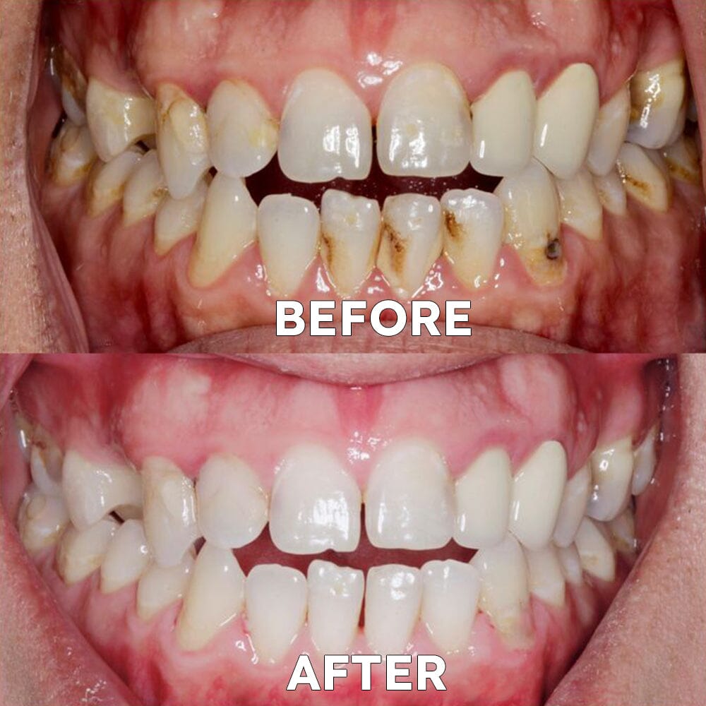 ✅Official Store | Ourlyard™ Tooth Health Mineral Powder🧑🏽⚕️Obtain American Dental Association (ADA) Certification(Treats periodontitis and mouth ulcers, prevents tooth loss, and repairs gum recession)