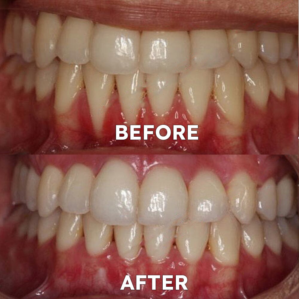 ✅Official Store | Ourlyard™ Tooth Health Mineral Powder🧑🏽⚕️Obtain American Dental Association (ADA) Certification(Treats periodontitis and mouth ulcers, prevents tooth loss, and repairs gum recession)