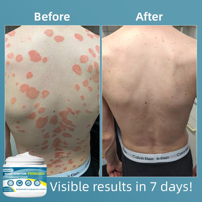 Ourlyard™ Multi-Symptom Psoriasis Treatment Cream(👨⚕Doctor's Recommendation)