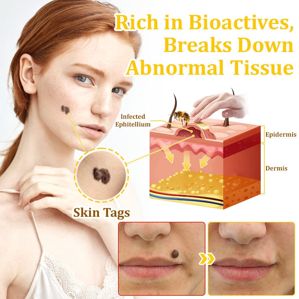 đâ
flysmus⢠Bee Venom Treatment Creamđ: Helps with Eczema, Psoriasis, Acne, Rosacea, Fungal Infections, and Warts