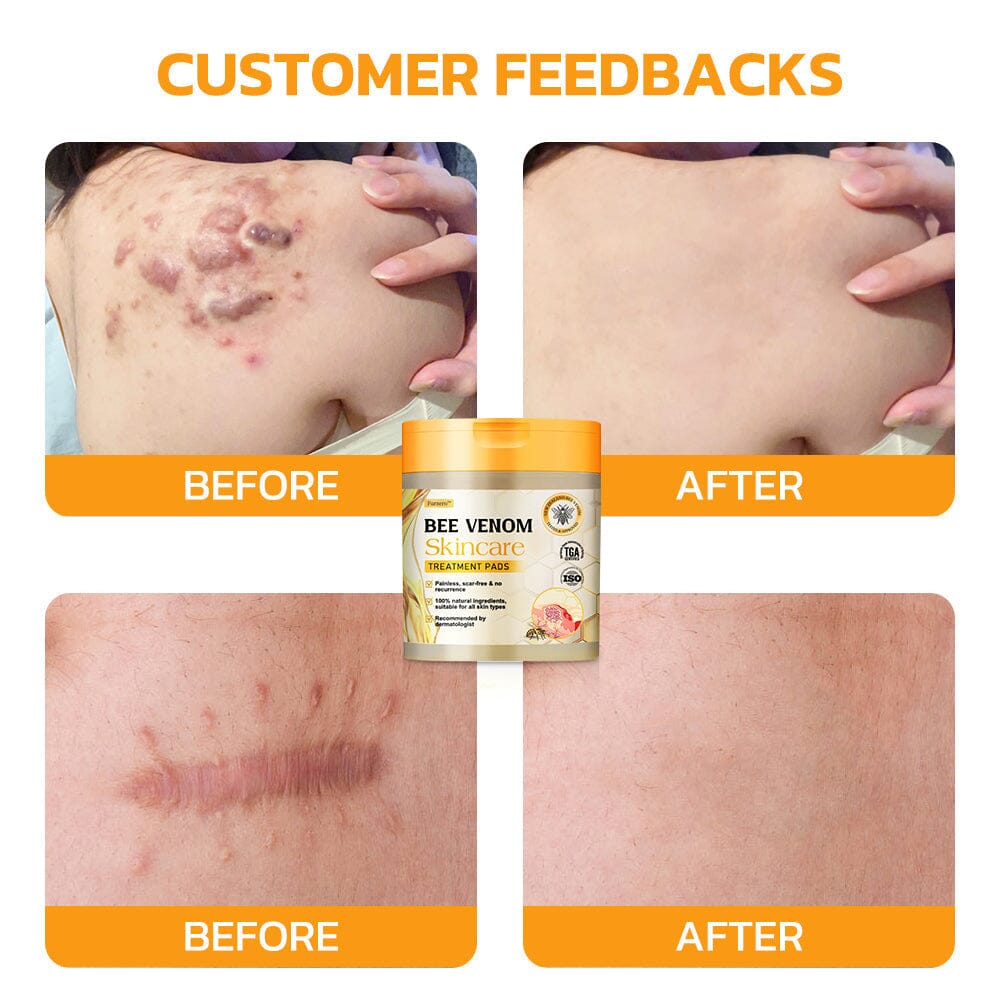 Therapeutic Products Directorate (TPD)✅ Furzero™ Bee Venom Skincare Treatment Pads (⚕️AAD Recommended)