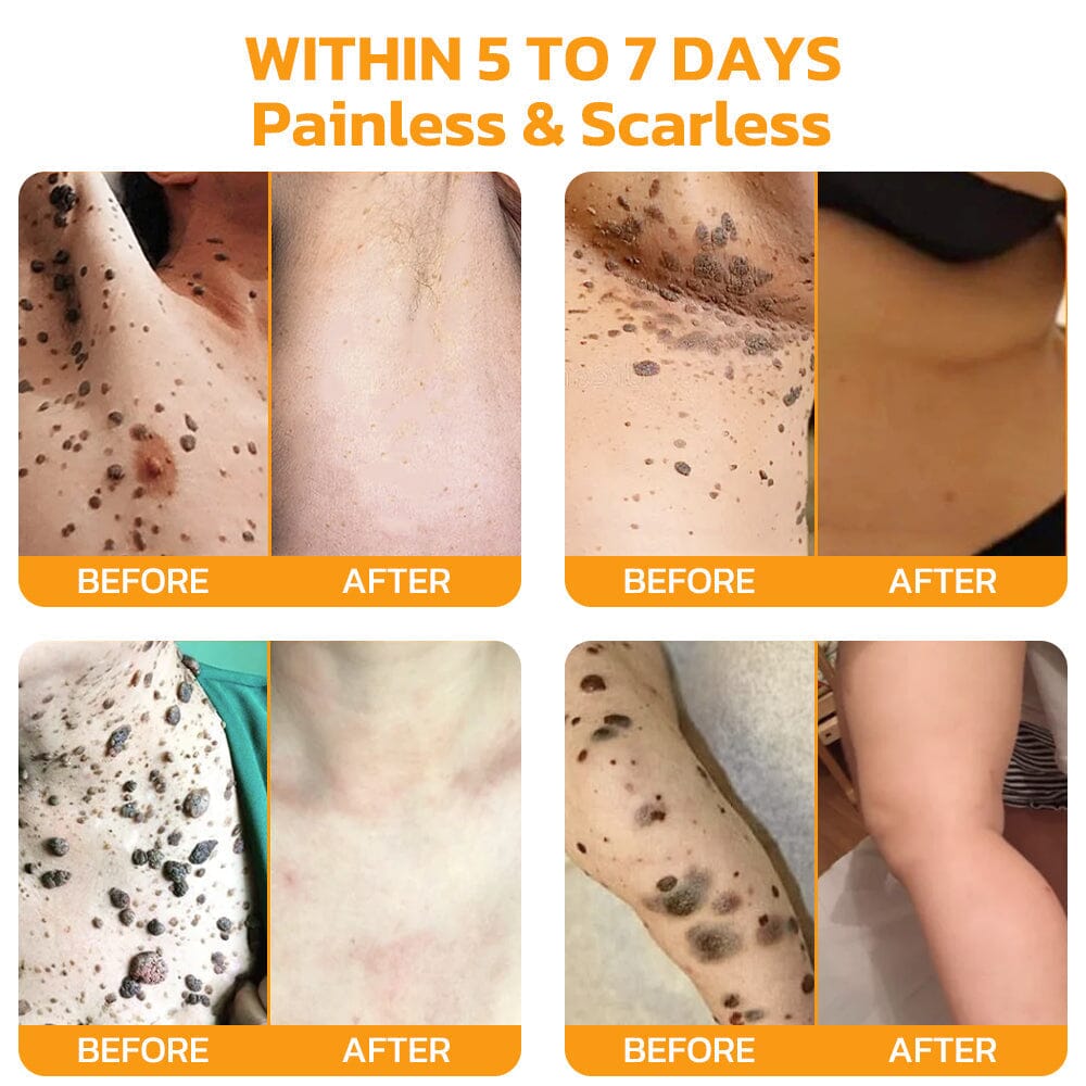 Therapeutic Products Directorate (TPD)✅ Furzero™ Bee Venom Skincare Treatment Pads (⚕️AAD Recommended)