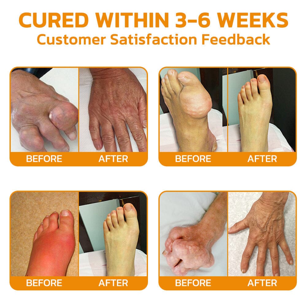 🇺🇸 Furzero™ Bee Venom Pain Suppression Joint Healing Cream (AAOS)Approved(Reducing joint swelling, pain, stiffness, redness, warmth, soreness, and joint fatigue)