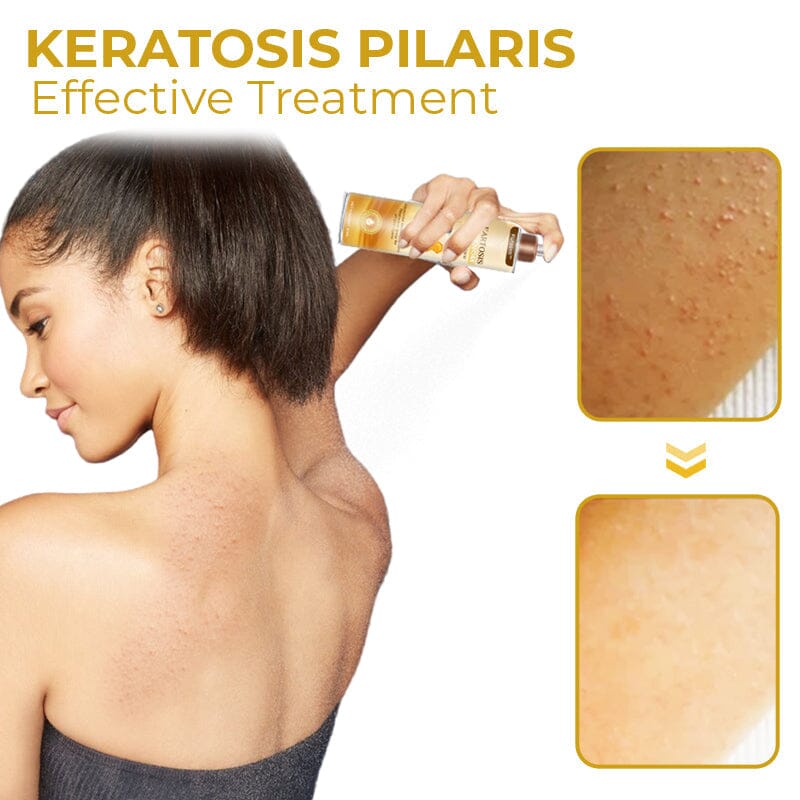 Furzero™ Cleartosis Bee Venom Keratosis Pilaris Spray