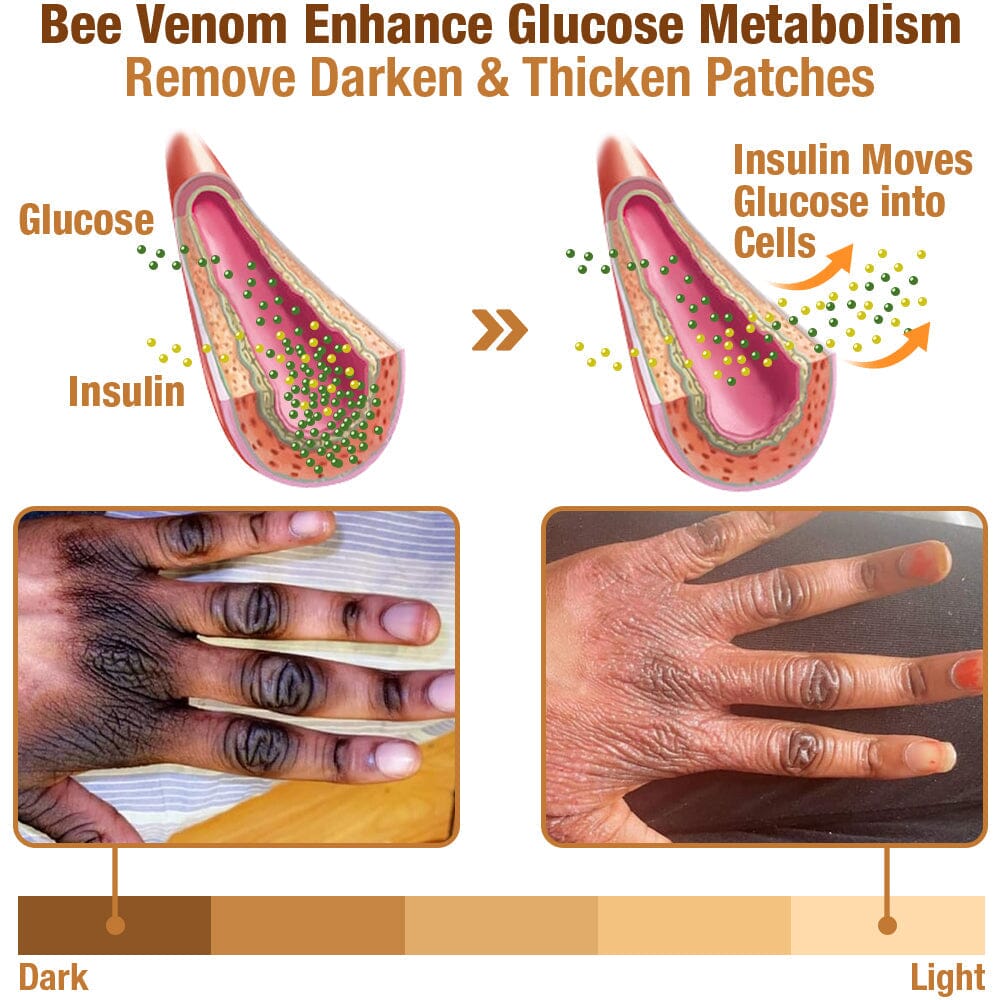 GFOUK™ ShineLuster Acanthosis Nigricans Bee Venom Soap