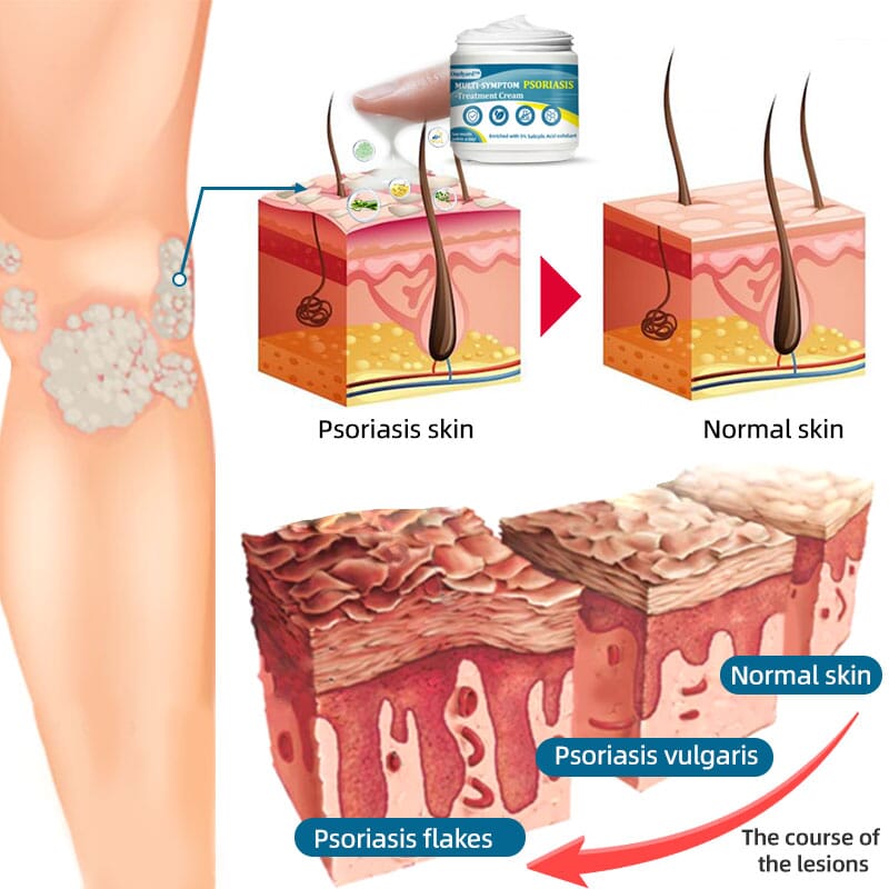 Ourlyard™ Multi-Symptom Psoriasis Treatment Cream(👨⚕Doctor's Recommendation)