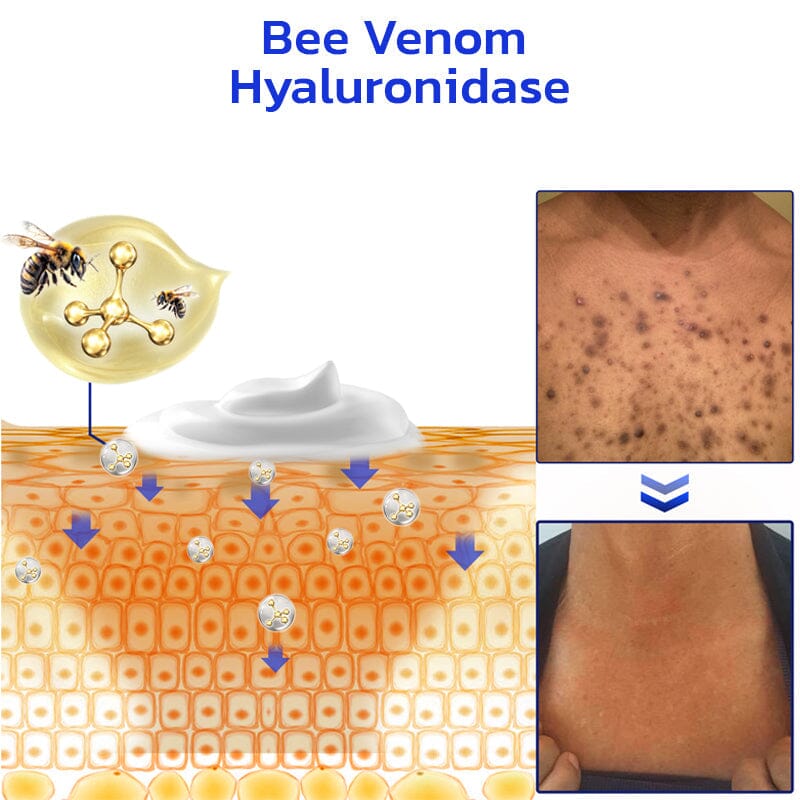 Furzero™ NonSpot Bee Venom Pigment Correction Cream