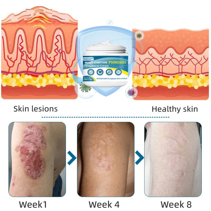 Ourlyard™ Multi-Symptom Psoriasis Treatment Cream(👨⚕Doctor's Recommendation)