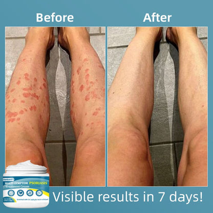 Ourlyard™ Multi-Symptom Psoriasis Treatment Cream（👨‍⚕Doctor's Recommendation）